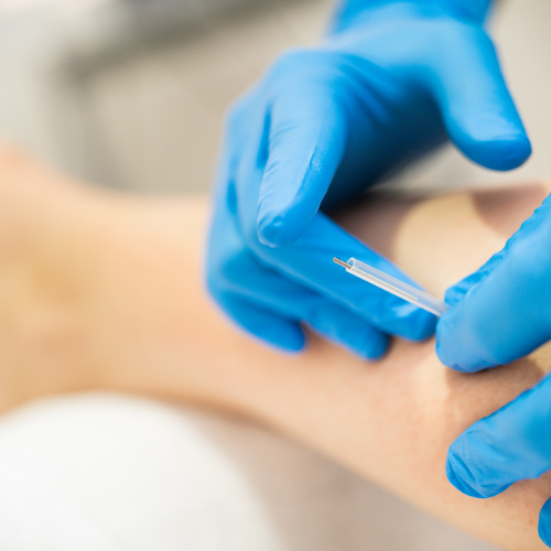 physiotherapy-center-dry-needling-msk-health-and-performance-clinic-vancouver-burnaby-metrotown-bc