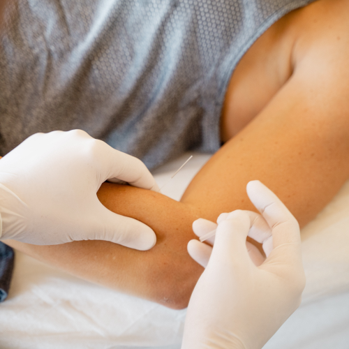 physiotherapy-center-ims-intramuscular-stimulation-msk-health-and-performance-clinic-vancouver-burnaby-metrotown-bc